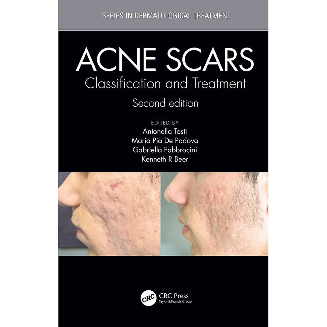 Acne Scars: and Treatment