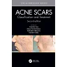 Acne Scars: and Treatment