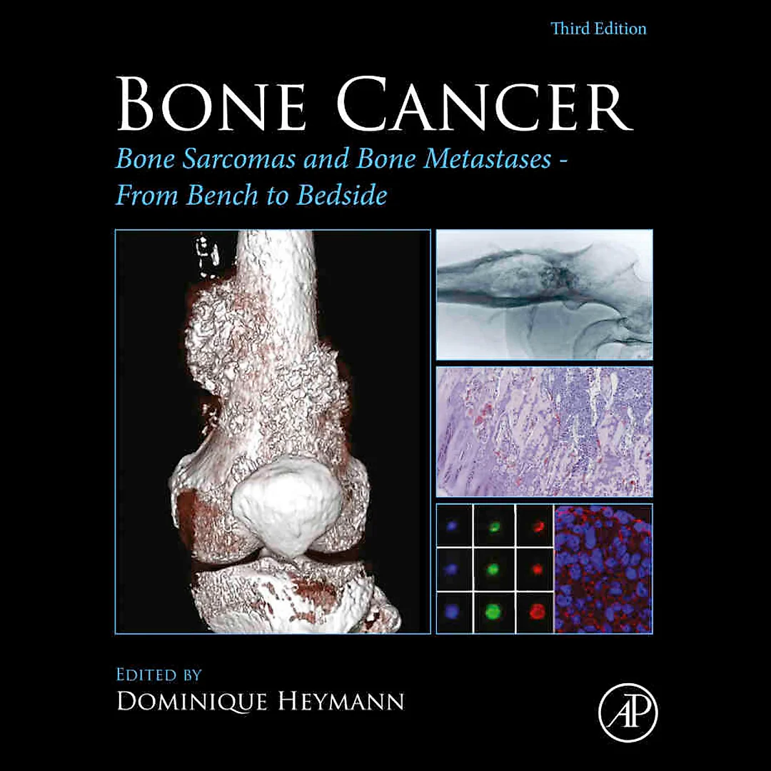Bone Cancer: Bone Sarcomas and Bone Metastases - From Bench to Bedside