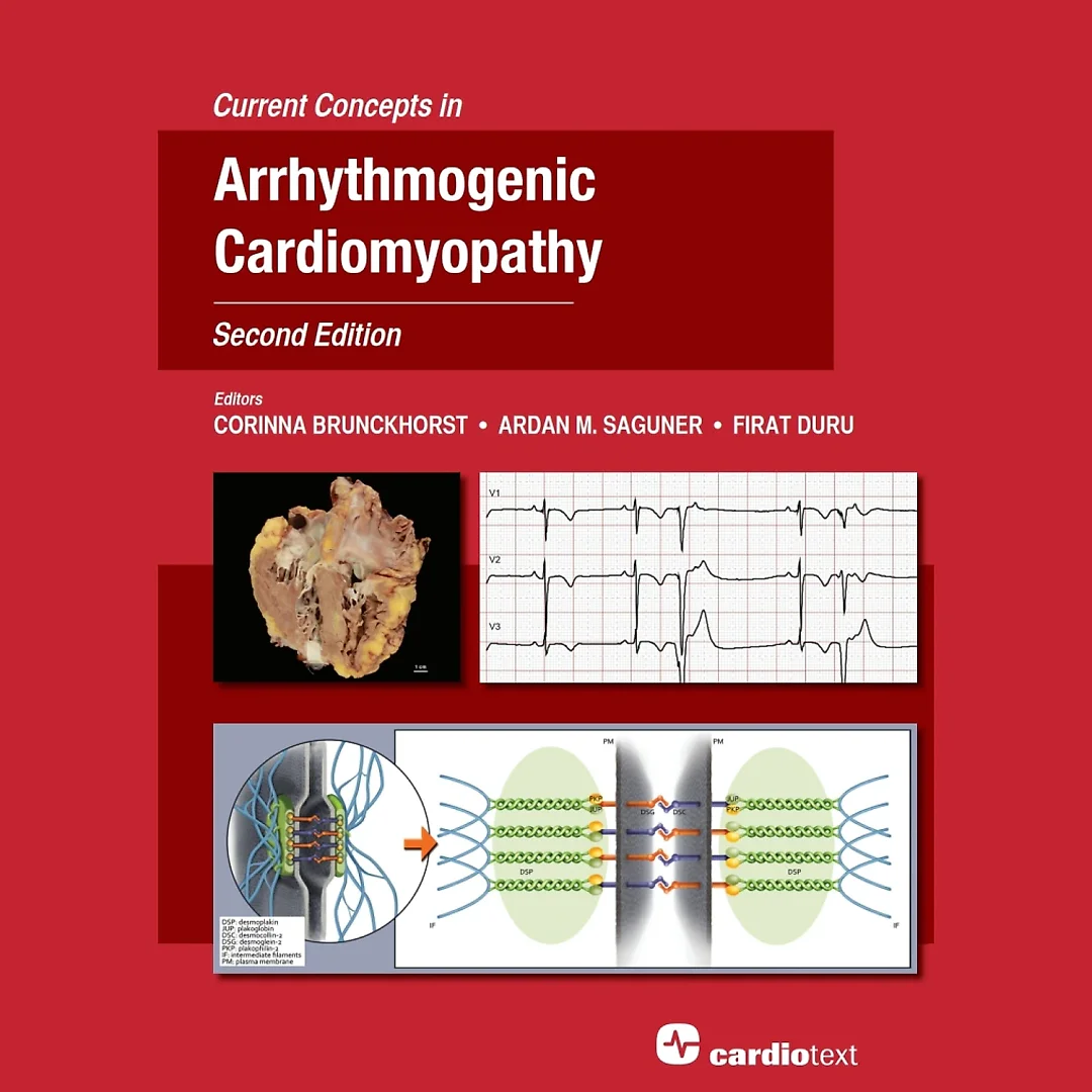 Current Concepts in Arrhythmogenic Cardiomyopathy, Second Edition