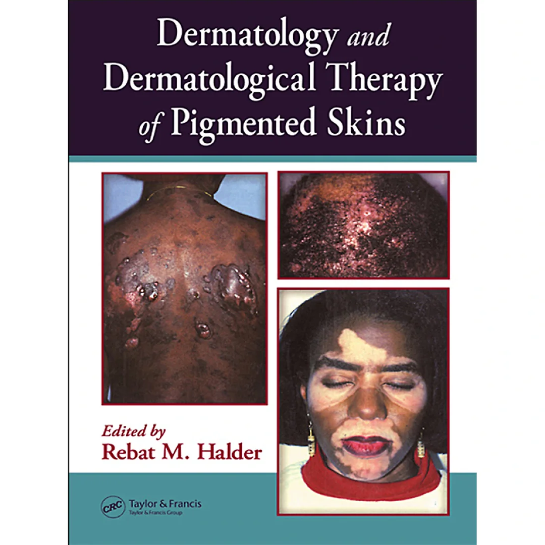 Dermatology and Dermatological Therapy of Pigmented Skins