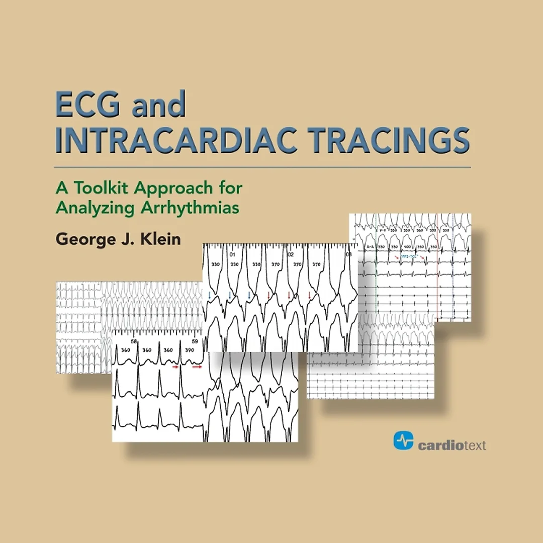 ECG and Intracardiac Tracings: A Toolkit Approach for Analyzing Arrhythmias