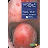 Fibroids and Reproduction