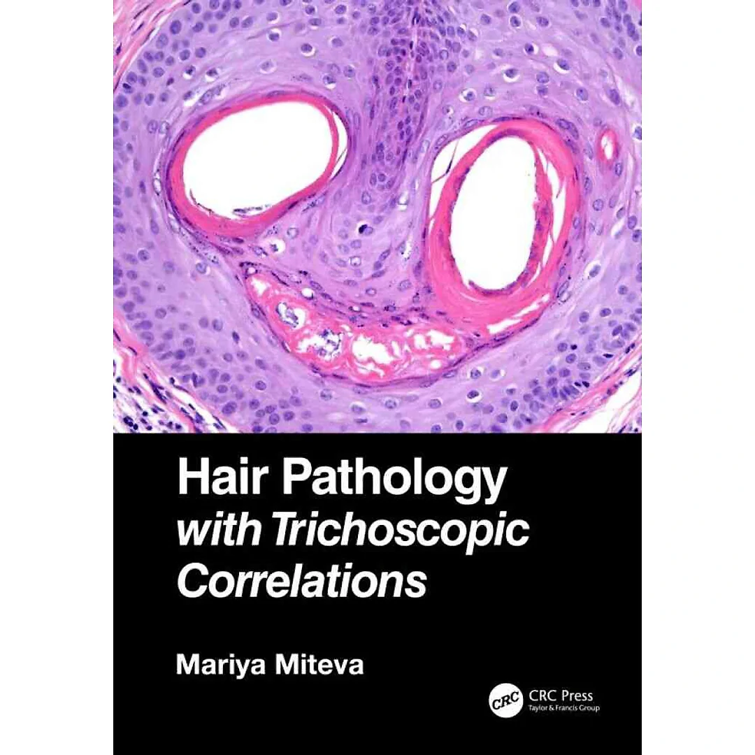 Hair Pathology with Trichoscopic Correlations