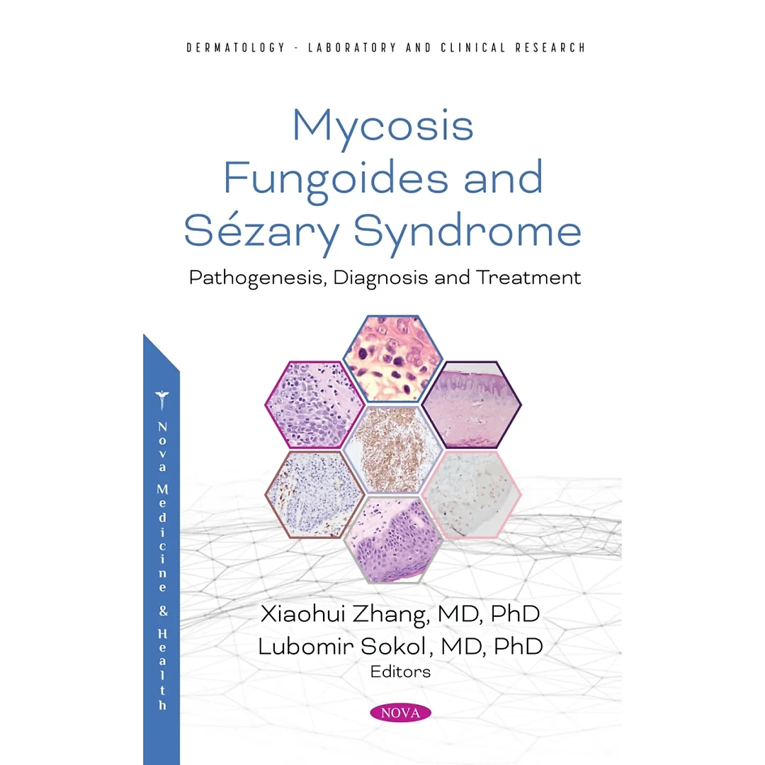 Mycosis Fungoides: Causes, Diagnosis and Treatment