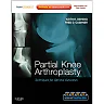 Partial Knee Arthroplasty