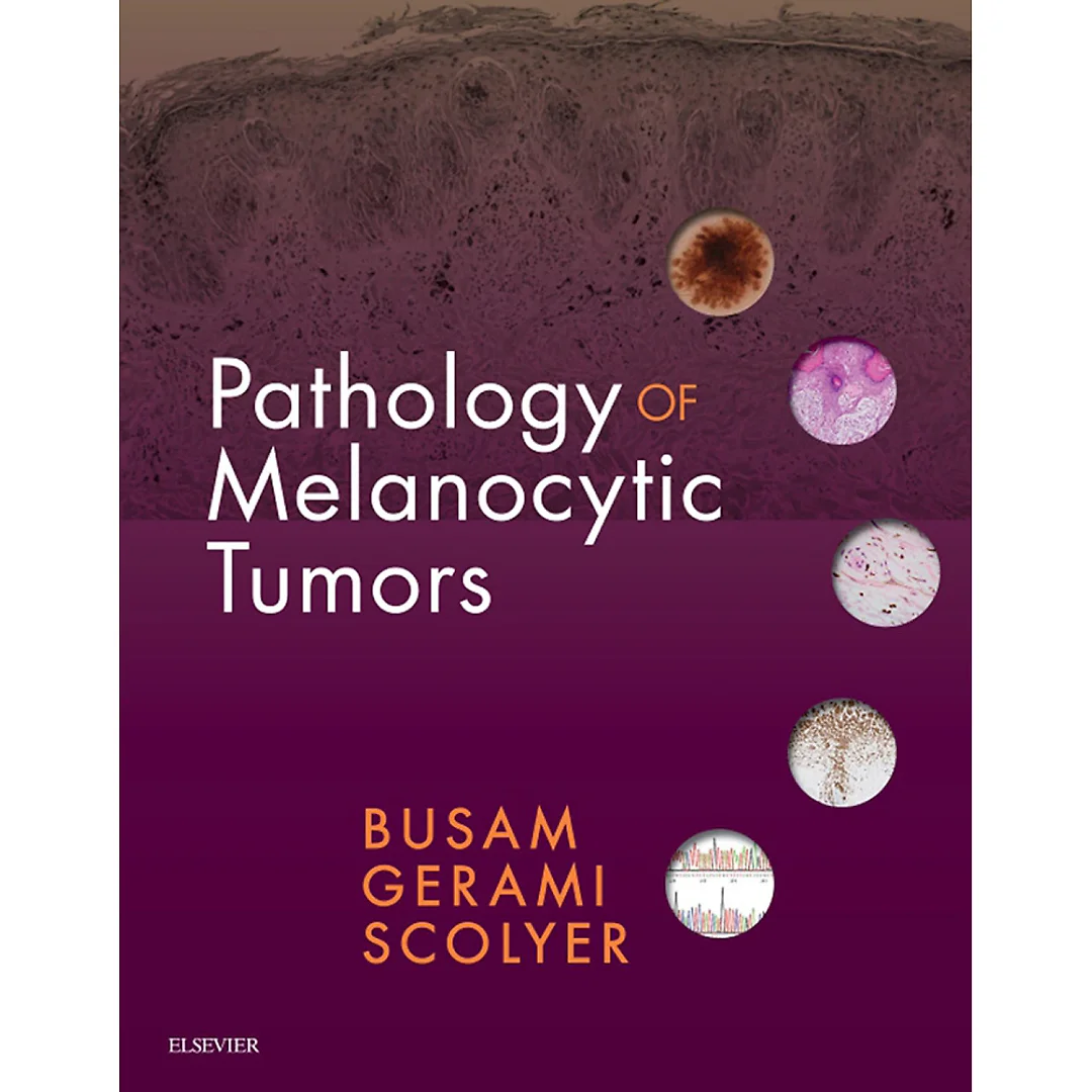 Pathology of Melanocytic Tumors