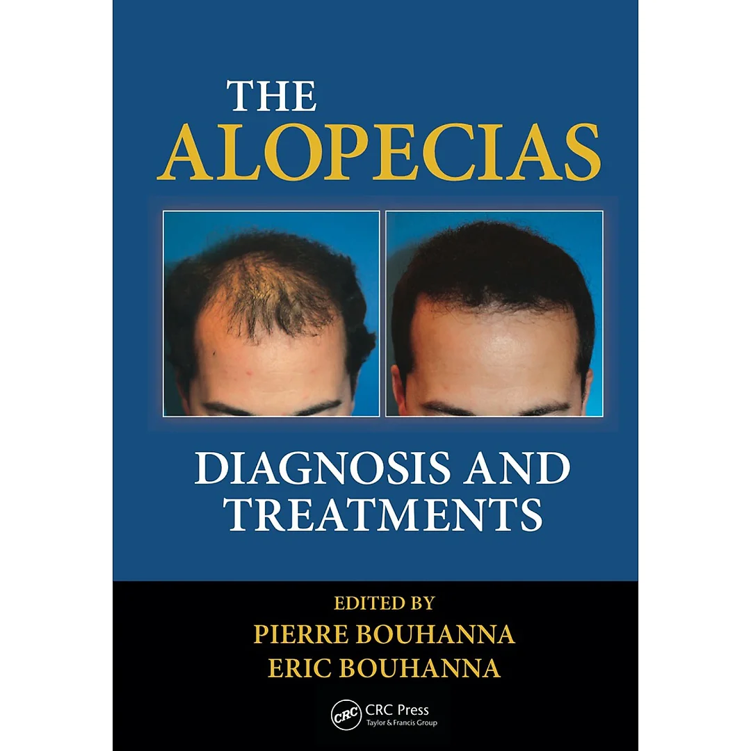 The Alopecias: Diagnosis and Treatments