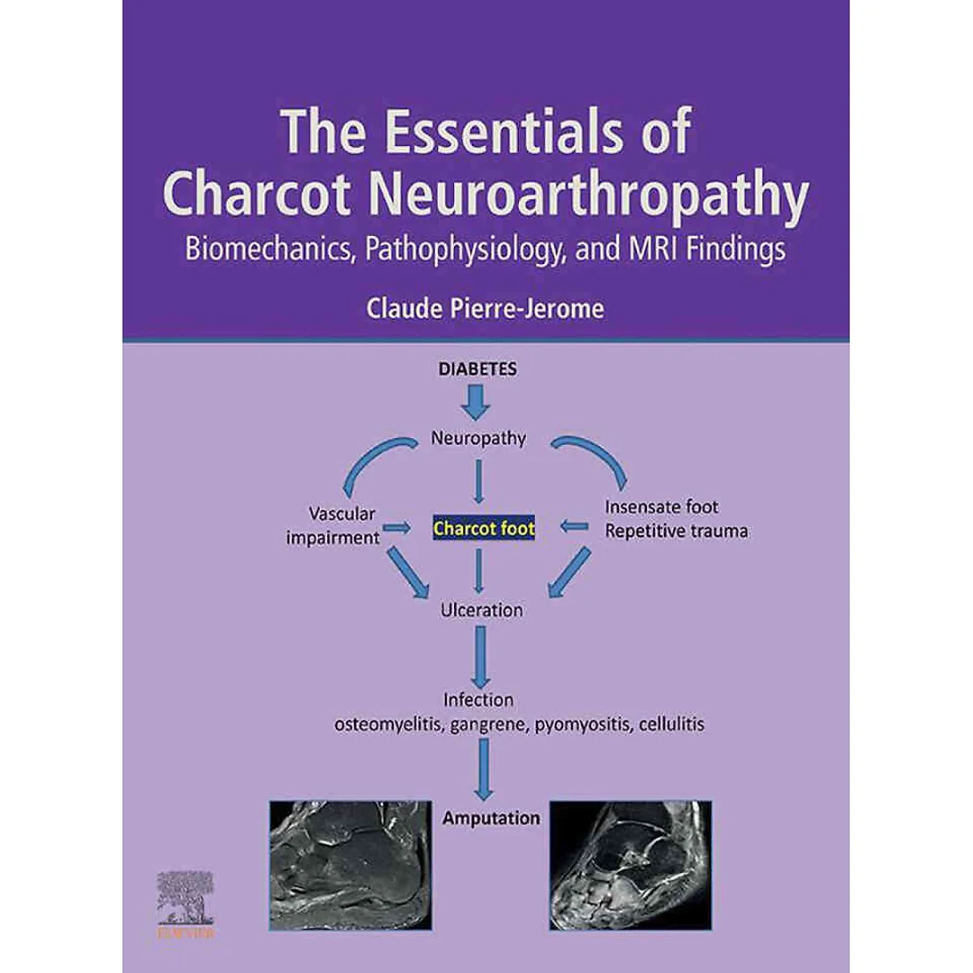 The Essentials of Charcot Neuroarthropathy: Biomechanics, Pathophysiology, and MRI Findings