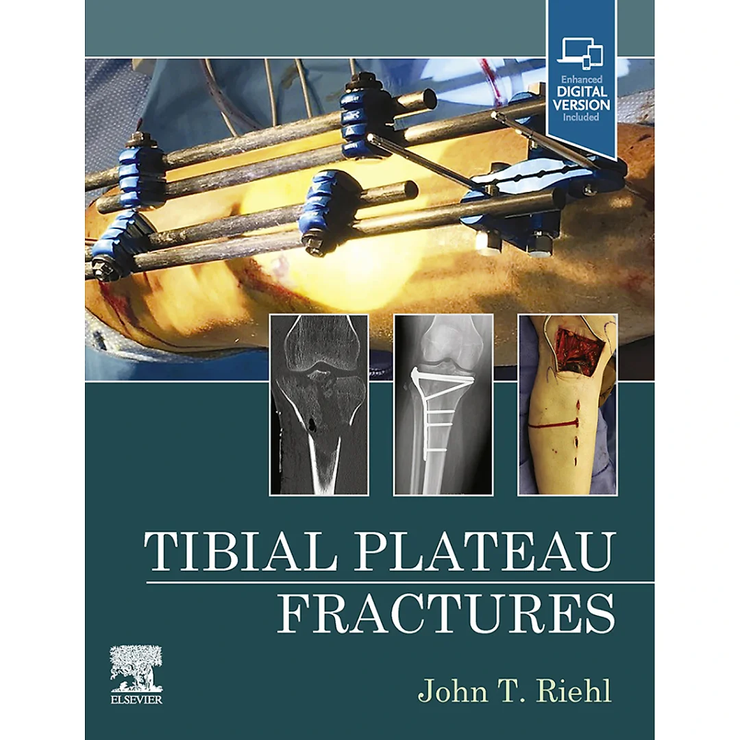 Tibial Plateau Fractures - E-Book