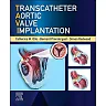 Transcatheter Aortic Valve Implantation