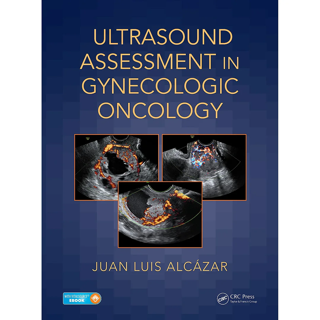 Ultrasound Assessment in Gynecologic Oncology