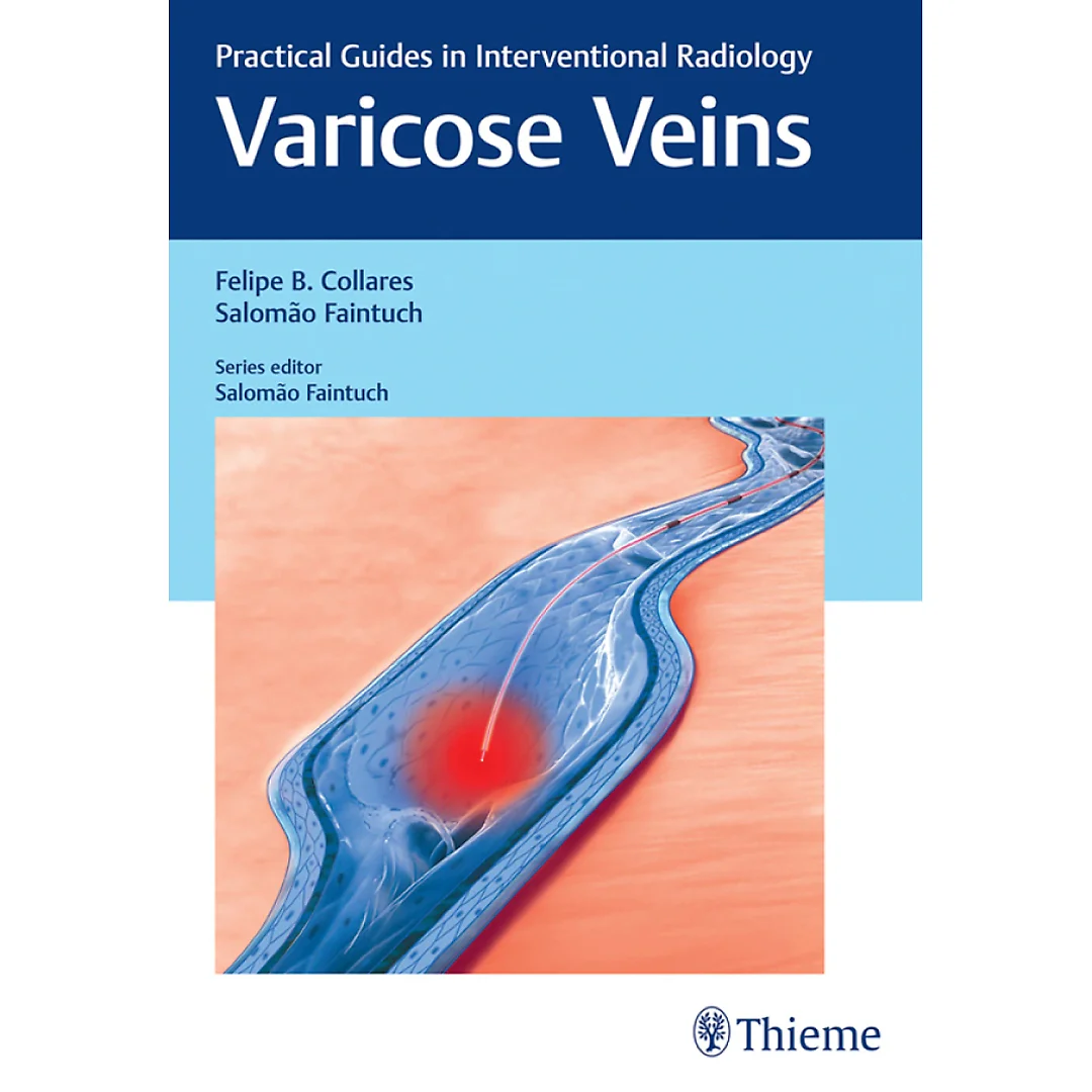 Varicose Veins: Practical Guides in Interventional Radiology